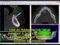 videos de Bioparts - Tutorial 9 DentalSlice: Planejando pinos fixadores