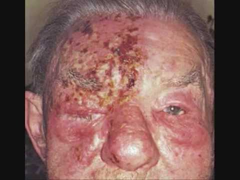 how to treat shingles