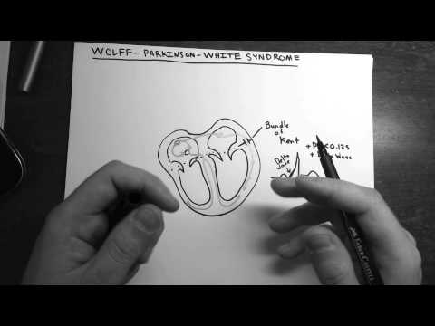 how to cure wpw syndrome