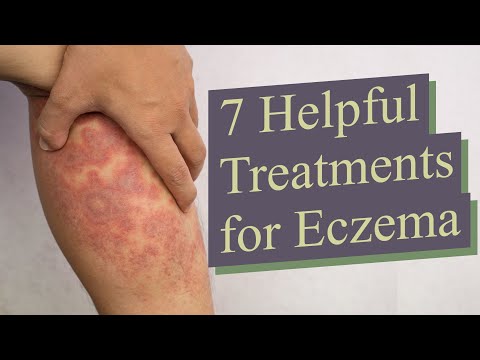 how to stop itching with eczema