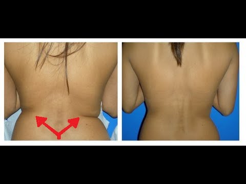 how to reduce upper back fat
