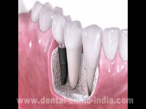 how to treat leukoplakia