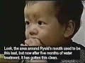Curing Atopic Dermatitis - www.HealthInWater.Homestead.com 1(866)620-9371 - Kangen Water