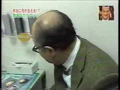 AGA治療