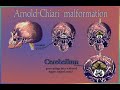 Arnold-Chiari Malformation