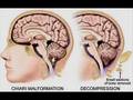 Arnold-Chiari Malformation