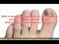 How to Cure Nail Fungus Infections Naturally