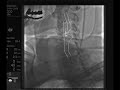 Carotid Stenting.flv