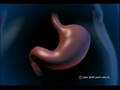 bariatric surgery video