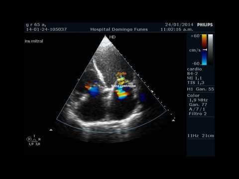 how to measure mr vena contracta