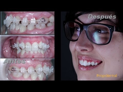 Ortodoncia estética de Yellow Mellow | El adiós de los brackets