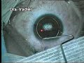 LASIK con Intralase