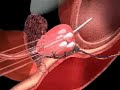Cryotheraphy (Freezing) of the Prostate for Prostate Cancer