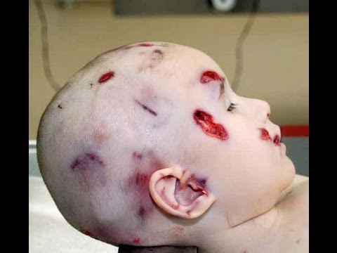Autopsy A Mothers Instinct - New York state Medical Examiner
