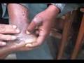 ネパールでのハンセン病活動/Leprosy elimination activities in Nepal