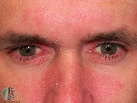 how to cure rashes on face fast
