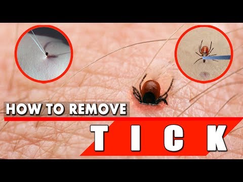 video-linktoworks-How to Remove a Tick Safely and Quickly - Tick Removal