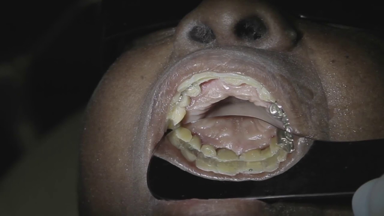 Prótese fixa instantânea feita com fibras e dentes de estoque