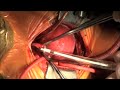 TAPVC, Total Anomalous Pulmonary Venous Return, Obstructed TAPVC, Total Anomalous Pulmonary Venous Return, Obstructed