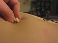 Huge back cyst drained