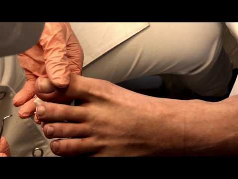 Eingewachsener Nagel, Unguis Incarnatus