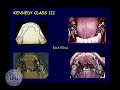 Lecture 5 in a course on creating removable prosthodontic appliances (dentures). This lecture covers the Kennedy partial denture classification system. This is part of the Open.Michigan collection at: open.umich.edu