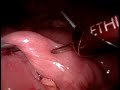 Cirurgia Obesidade