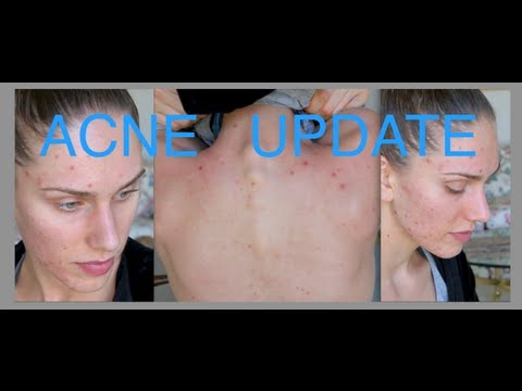 Acne Update For Acne Awareness Month! Sunscreen, Skincare Routine, Summer & Herbal Supplements!