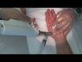 videos de Botox® injections with needles