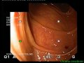 Jejunostomy Tube Location Jejunostomy Tube Location