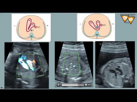 EYLÜL AYI OLGUSU  SAĞ AORTİK ARK