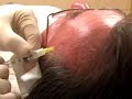 Dr. Coyle Connolly Performs a Skin Cancer Biopsy