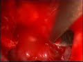 II Look: endoscopic transcanal approach II Look: endoscopic transcanal approach
