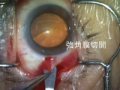耳側強角膜一手法ダイジェスト Scleral-corneal incision cataract surgery (one hand).