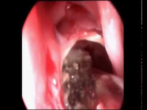 how to kill sinus fungus
