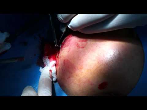 how to drain submandibular abscess