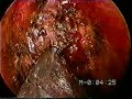 CEPHALOCELE CEREBROSPINAL FLUID LEAK CEPHALOCELE CEREBROSPINAL FLUID LEAK