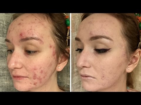Чем скрыть прыщи на лице косметика Чем скрыть прыщи на лице косметика