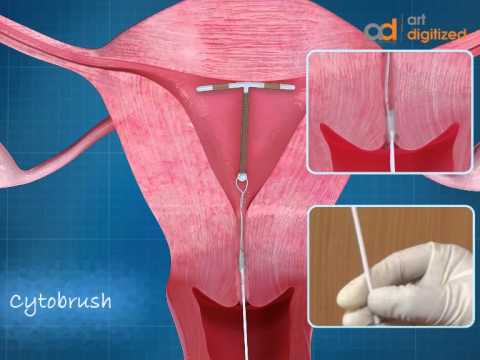 how to relieve iud pain