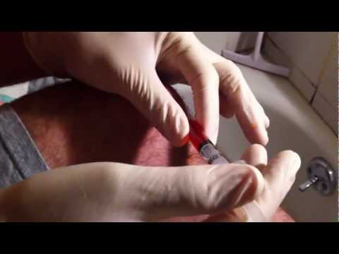 how to drain fluid from knee joints