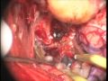 Anterior Clinoidal Meningioma