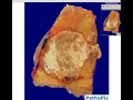 Histopathology Interphalangeal joint of toe --Gout
