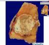 Histopathology Interphalangeal joint of toe --Gout