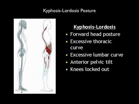 how to cure kyphosis and lordosis