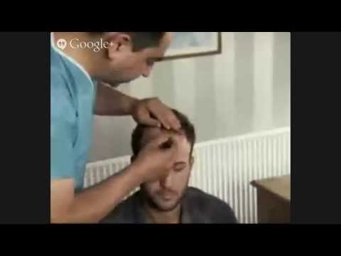 how to get a free hair transplant uk