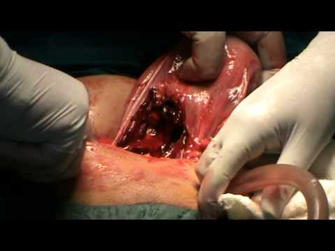 how to repair uterine rupture
