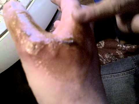 how to treat 3rd degree burn at home