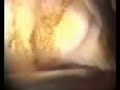 Mioma submucoso n�vel 1