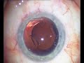 Implantation of Human Optics 1CU Accomodating IOL