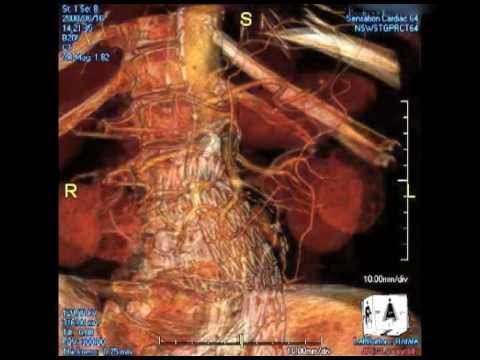 how to repair arteries